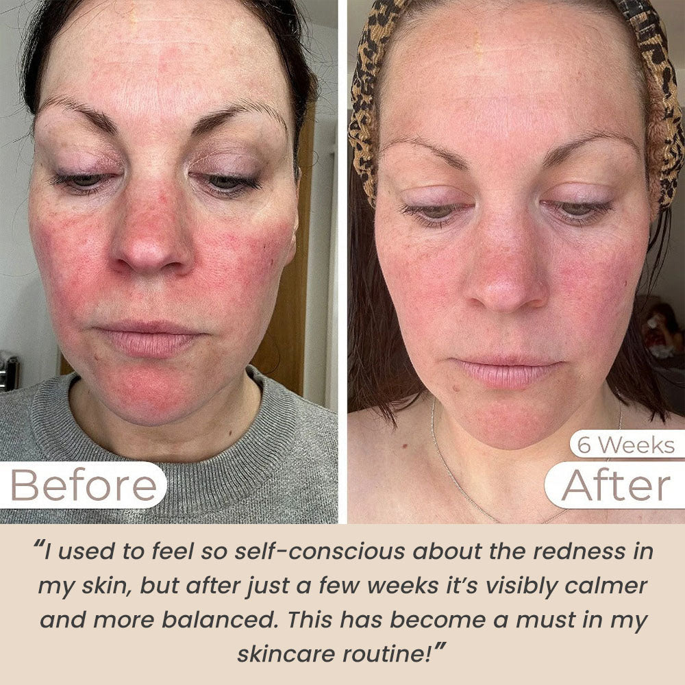Light Therapy Face Mask