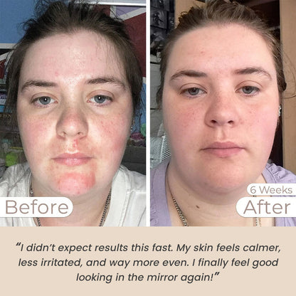 Light Therapy Face Mask