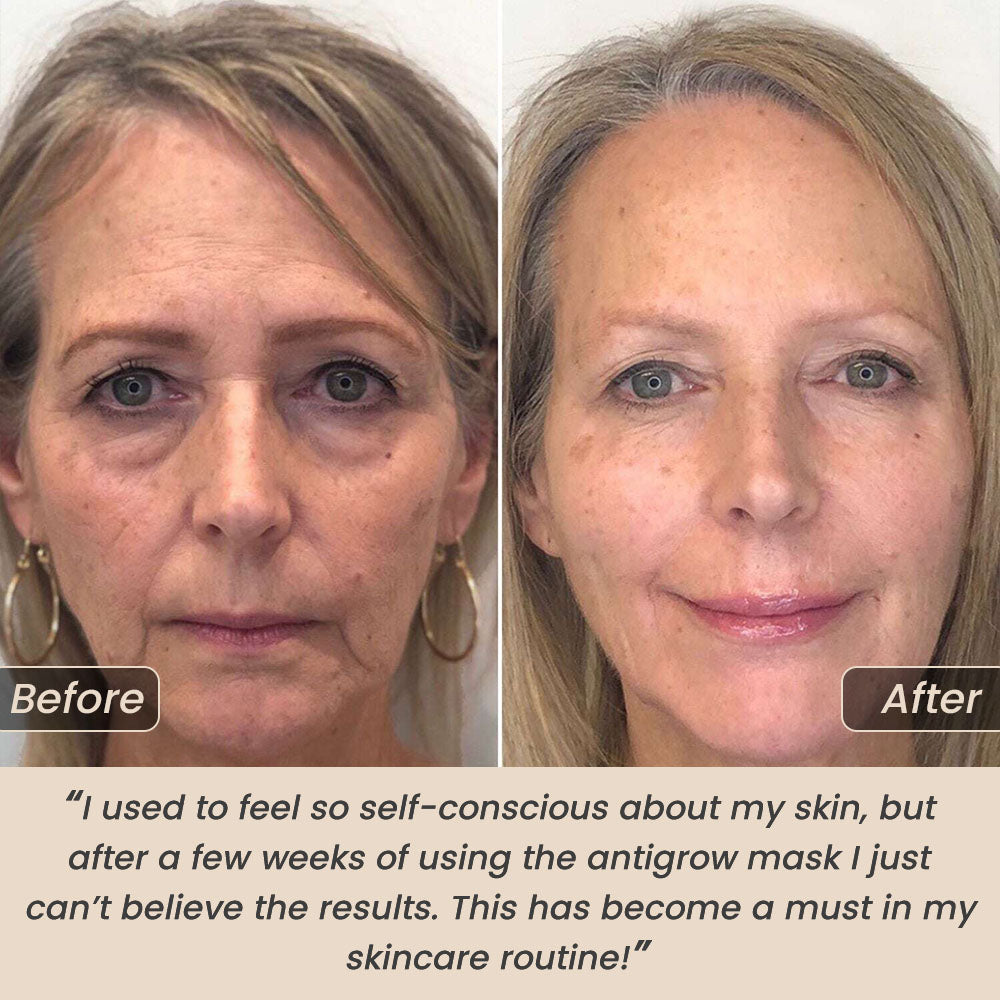 AntiGrow™ Light Therapy Mask